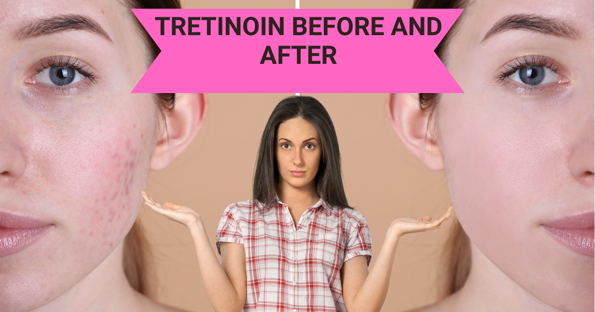 tretinoin before and after